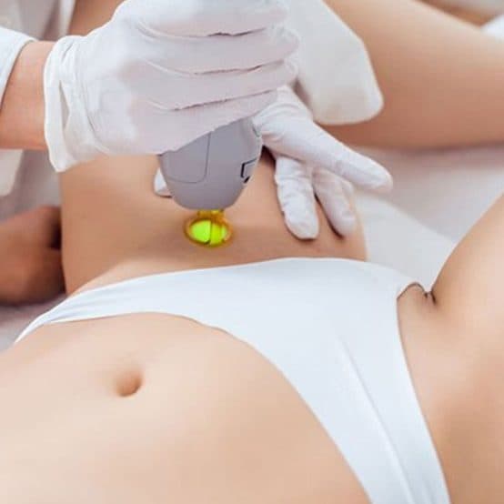 Gloved hand performing laser hair removal with a yellow light device on the bikini area.