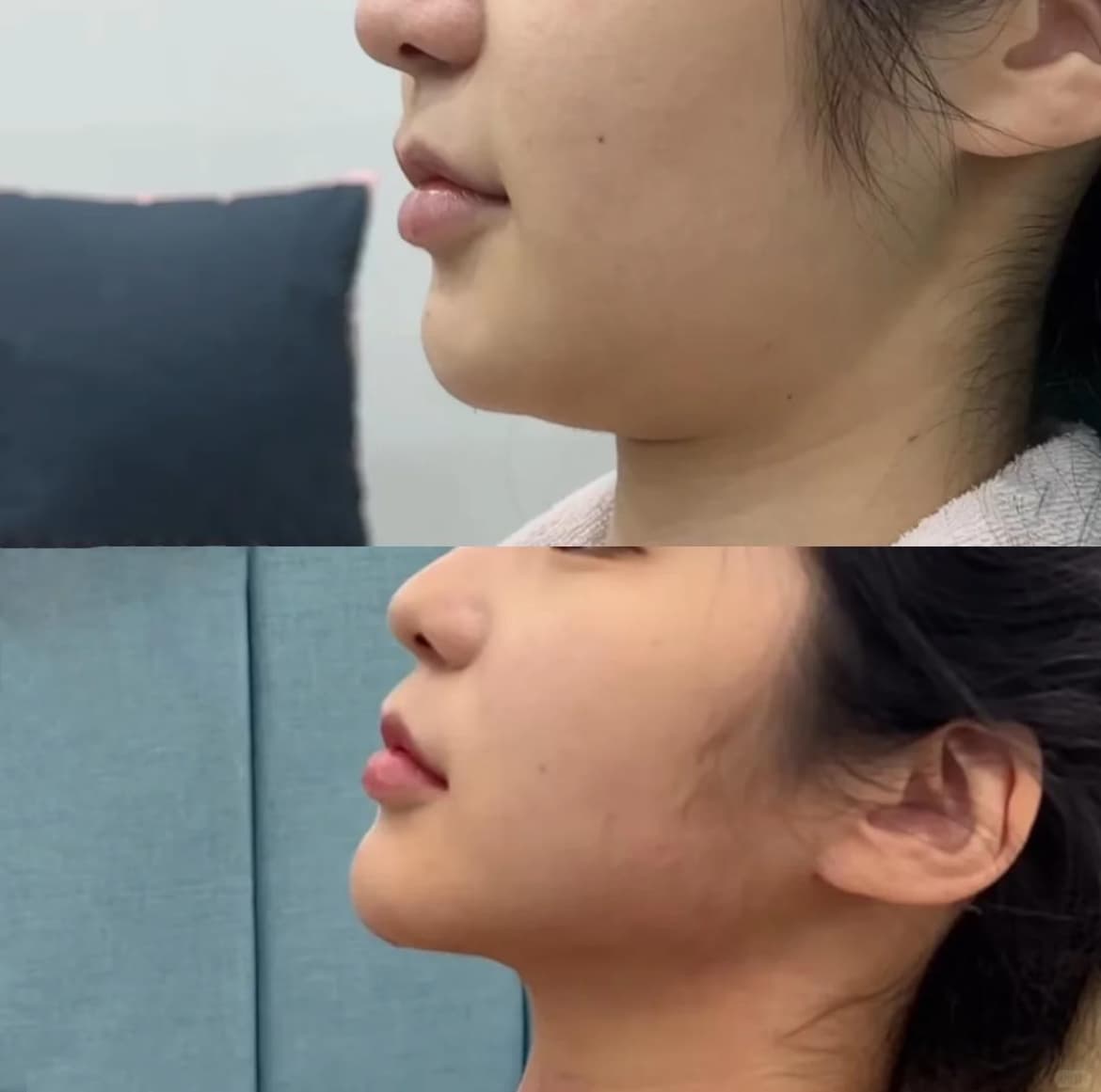 Before and after side profile photos showing a more defined jawline and sculpted chin.