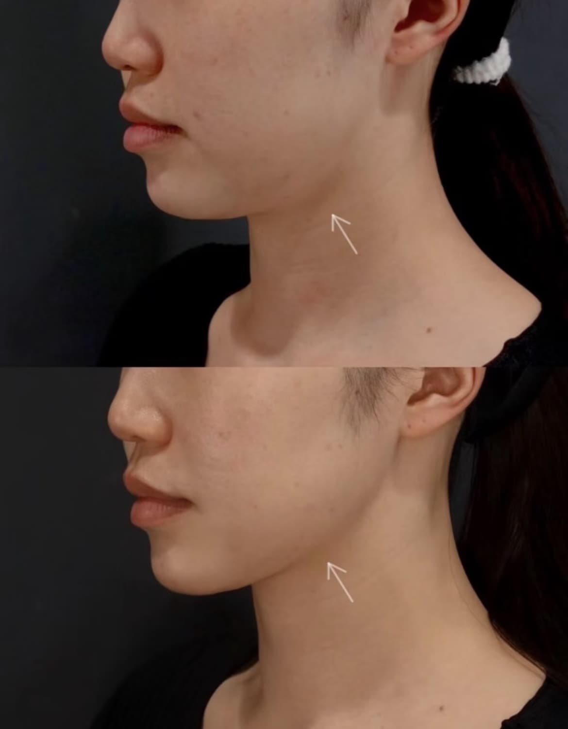 Side profile comparison showing a more defined jawline and tighter neck skin after treatment.