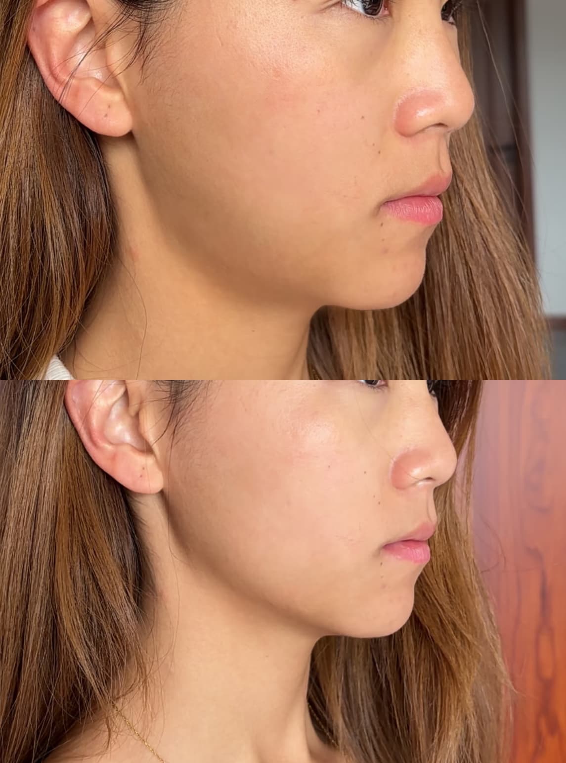 Side profile comparison of a woman's face showing subtle improvements in jawline and chin definition.