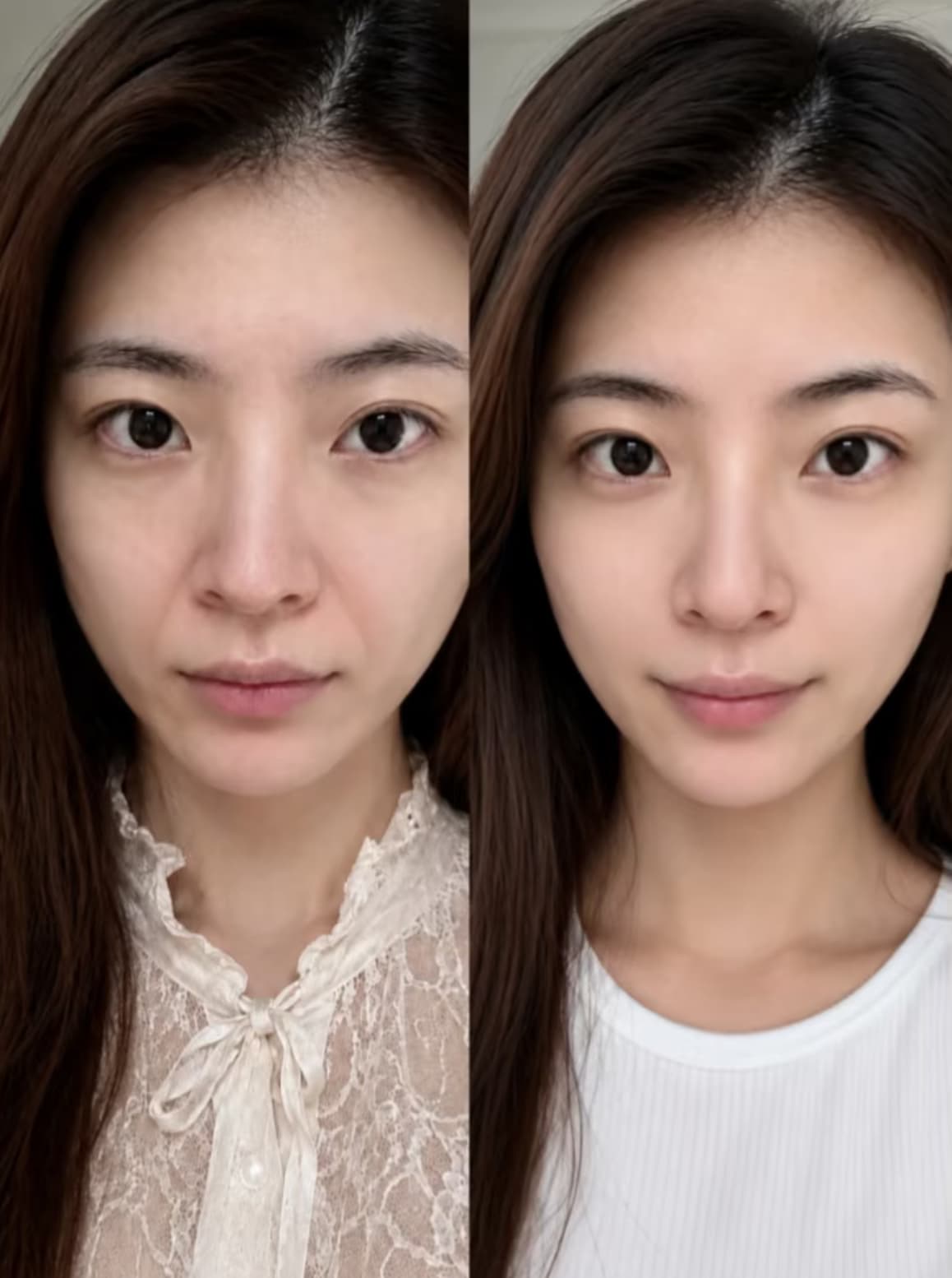 Side-by-side comparison of a woman's face showing skin smoothing and reduced nasolabial folds.