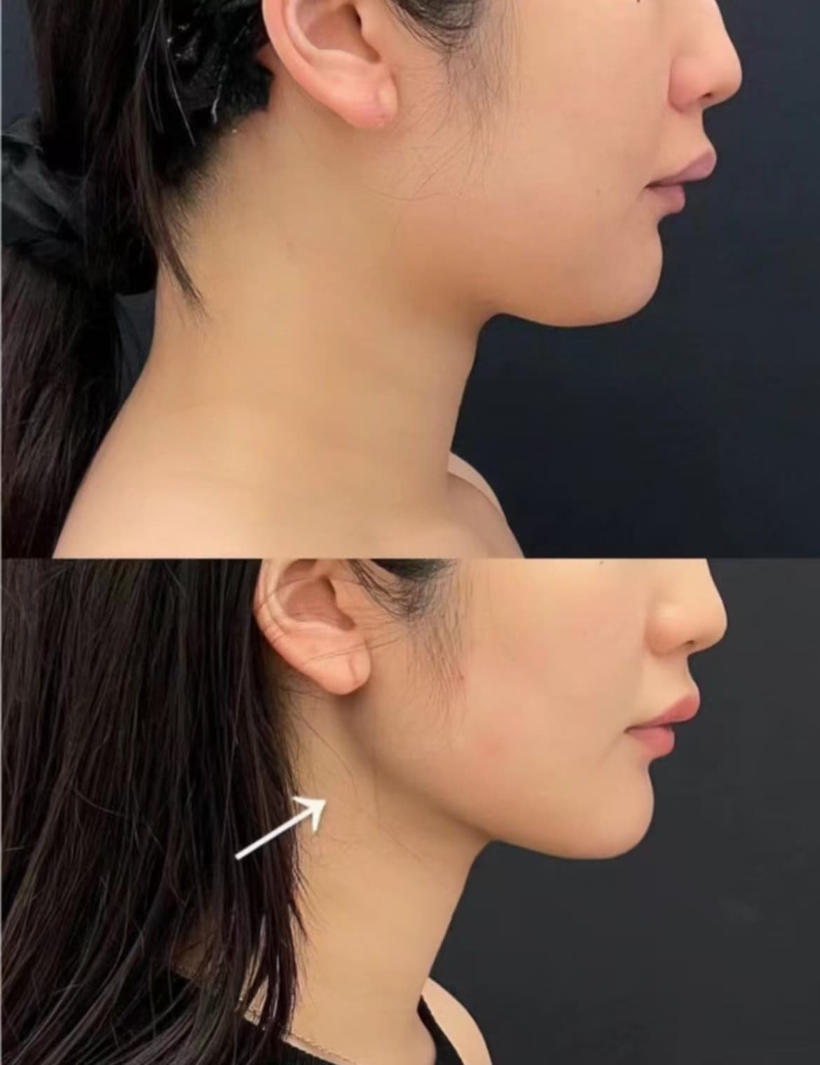 Side profile comparison showing a more defined and sharper jawline after a cosmetic procedure.