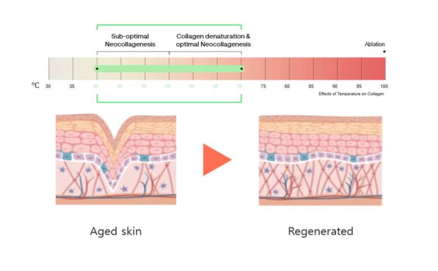 Temperature chart for neocollagenesis, illustrating aged skin with wrinkles transforming into smooth, regenerated skin.