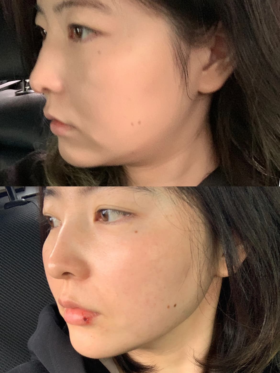 Two side profile photos of a woman's face, showing a small red mark on her lip.
