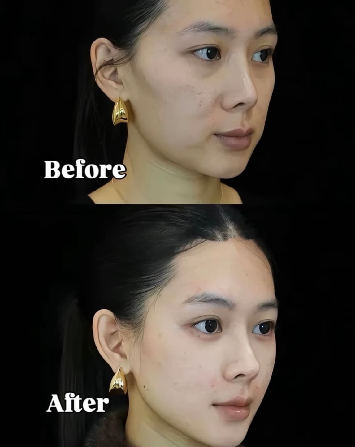 Before and after comparison of a woman's face showing a more defined, sculpted jawline.