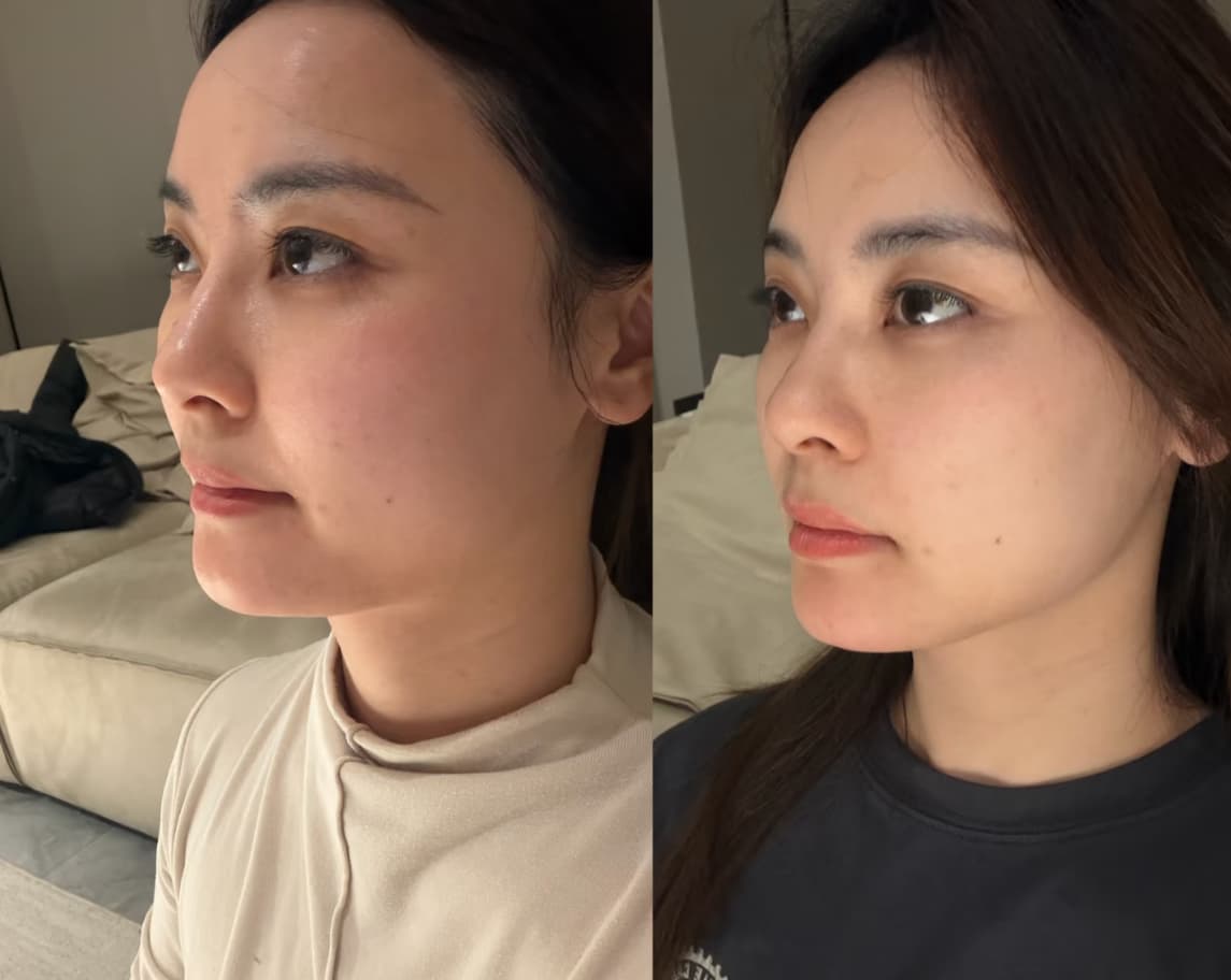Side-by-side comparison of a woman's face showing a more defined and contoured jawline profile.