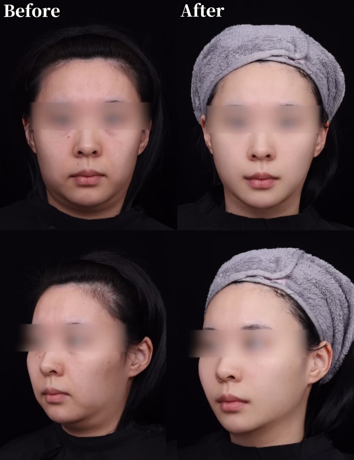 Before and after front and side views showing a woman's slimmer, more defined jawline.