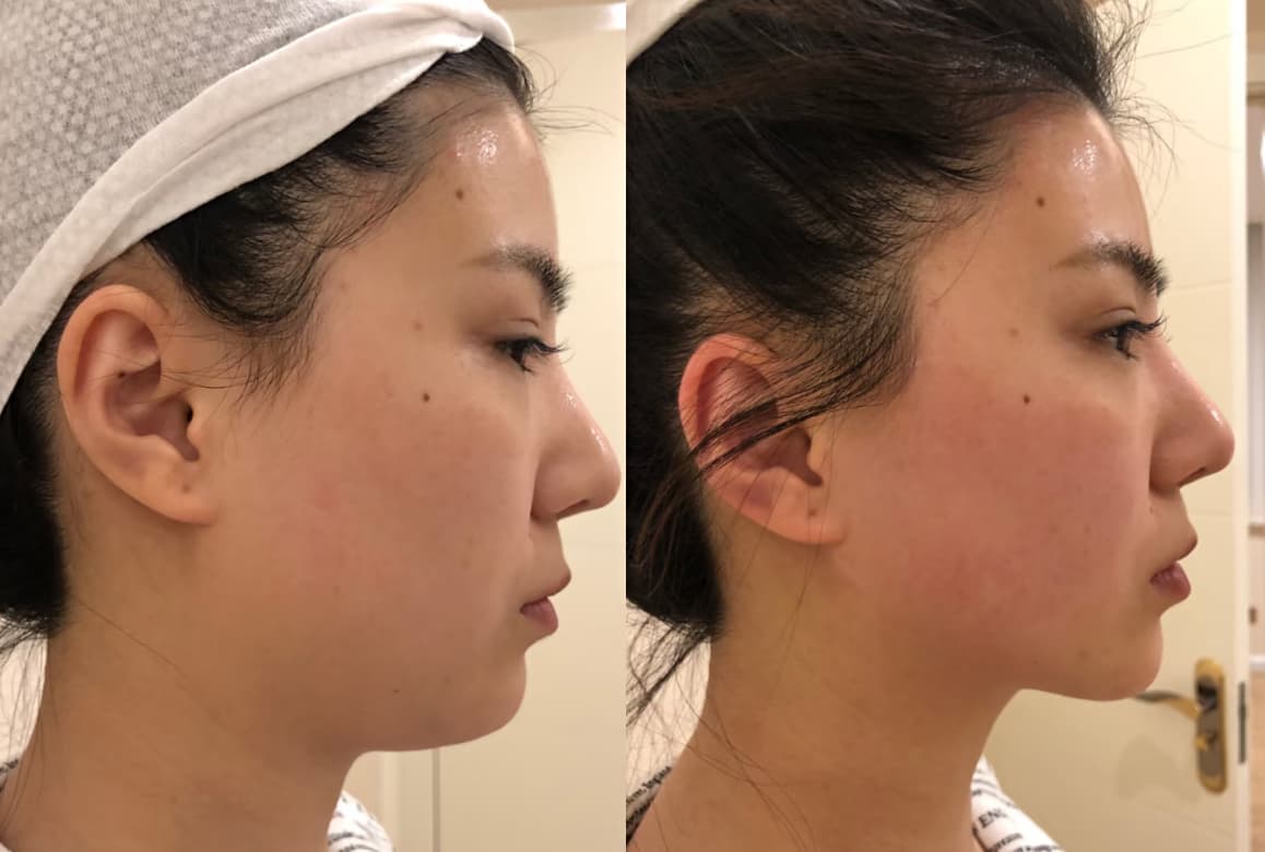 Side profile comparison of a woman's face showing improved jawline and chin definition.