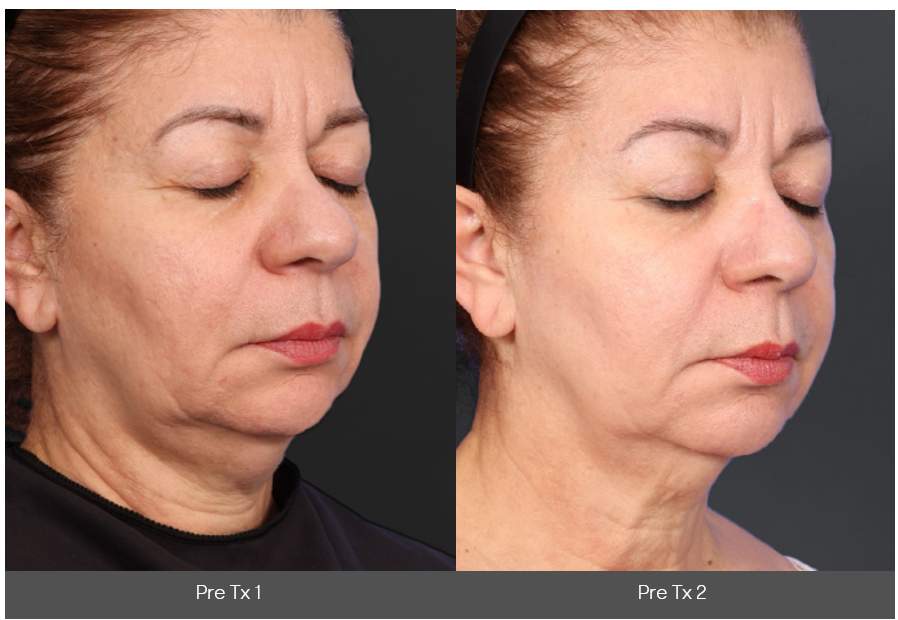 Comparison of a woman's jawline showing skin tightening results between two cosmetic treatment sessions.