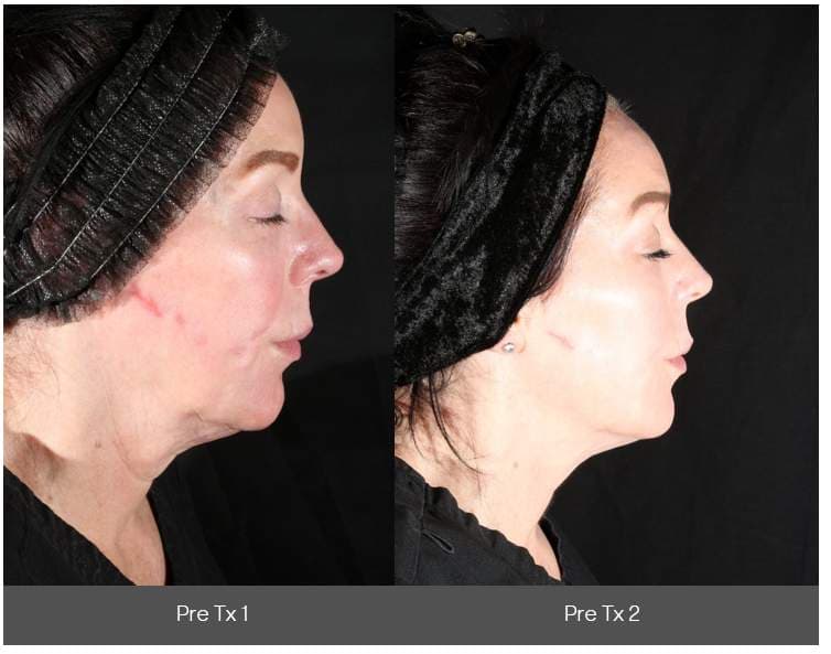 Side-by-side profile comparison showing visible improvement in jawline contour and neck skin tightness.