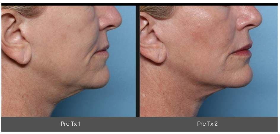 Side-by-side profile photos showing improved jawline definition and tighter neck skin after cosmetic treatment.