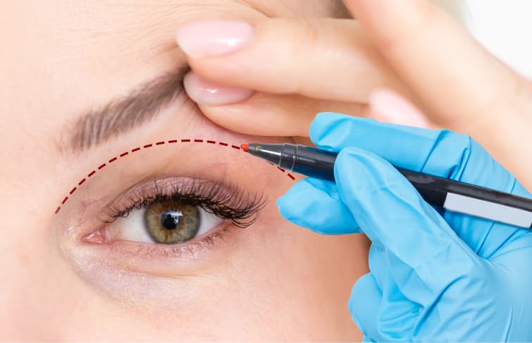 Surgeon marking a red dashed line on a patient's eyelid for a blepharoplasty procedure.