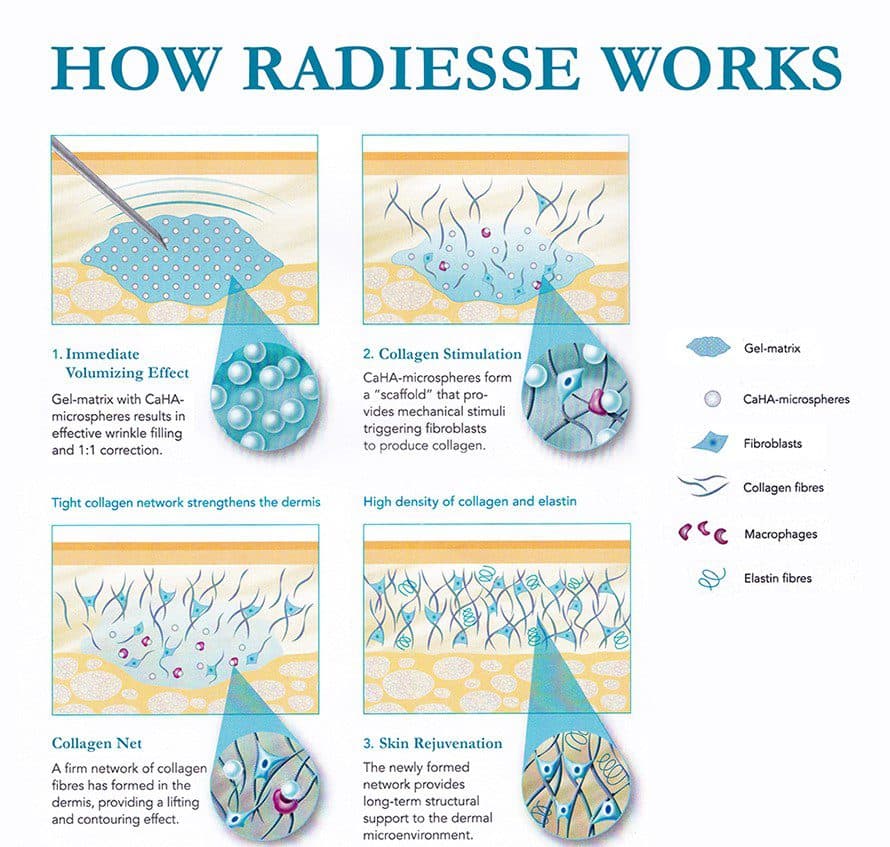 Infographic showing Radiesse dermal filler's four steps from immediate volumizing to long-term collagen stimulation.