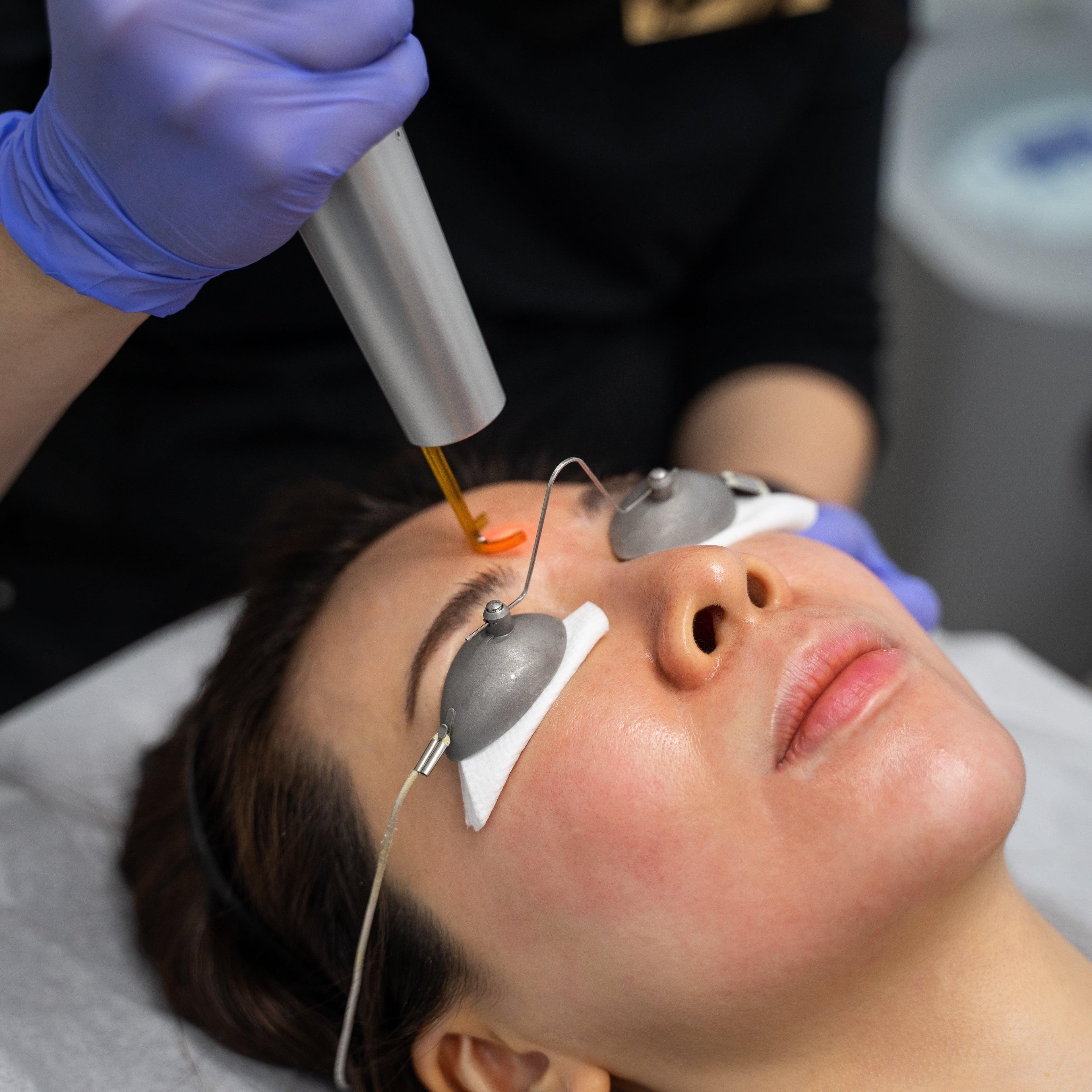 Woman wearing protective eye shields receives a professional laser facial treatment on her forehead.