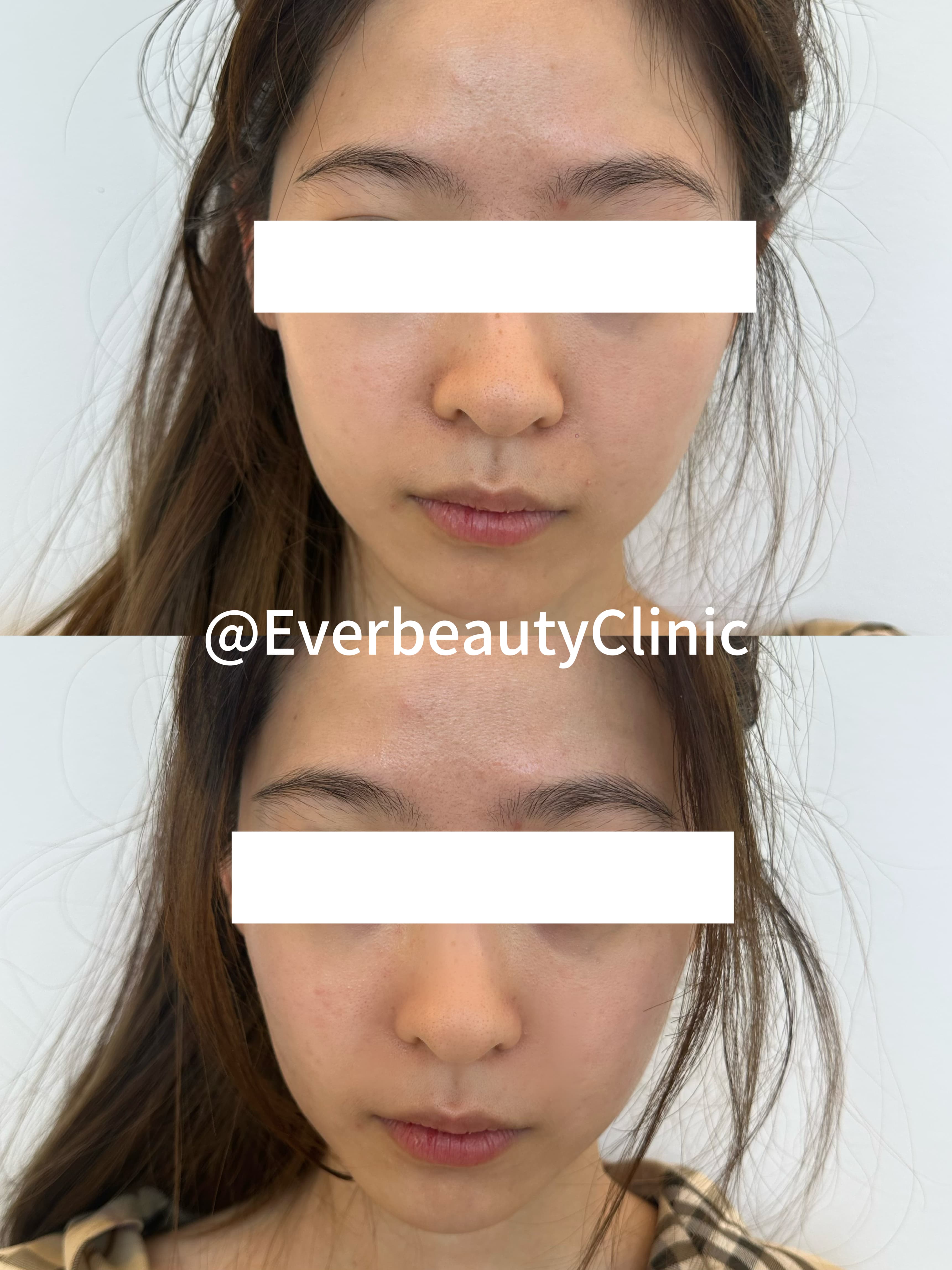 Before and after comparison of a woman's facial contouring treatment results at Everbeauty Clinic.