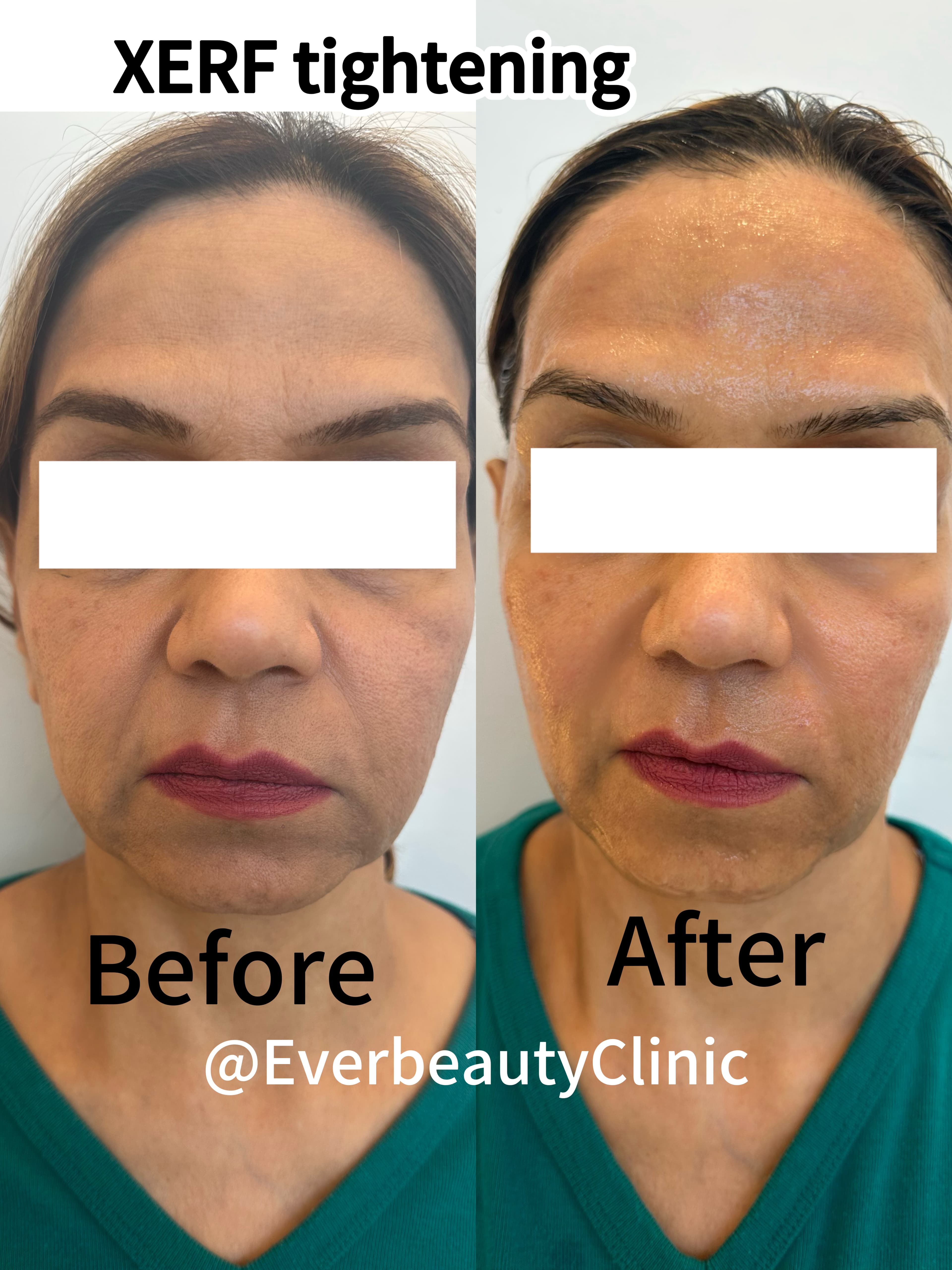 Before and after comparison of XERF skin tightening results on a woman's face.