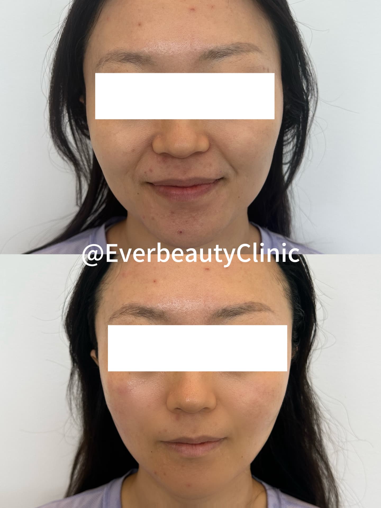 Before and after comparison of a woman's face showing reduced nasolabial folds and smoother skin.