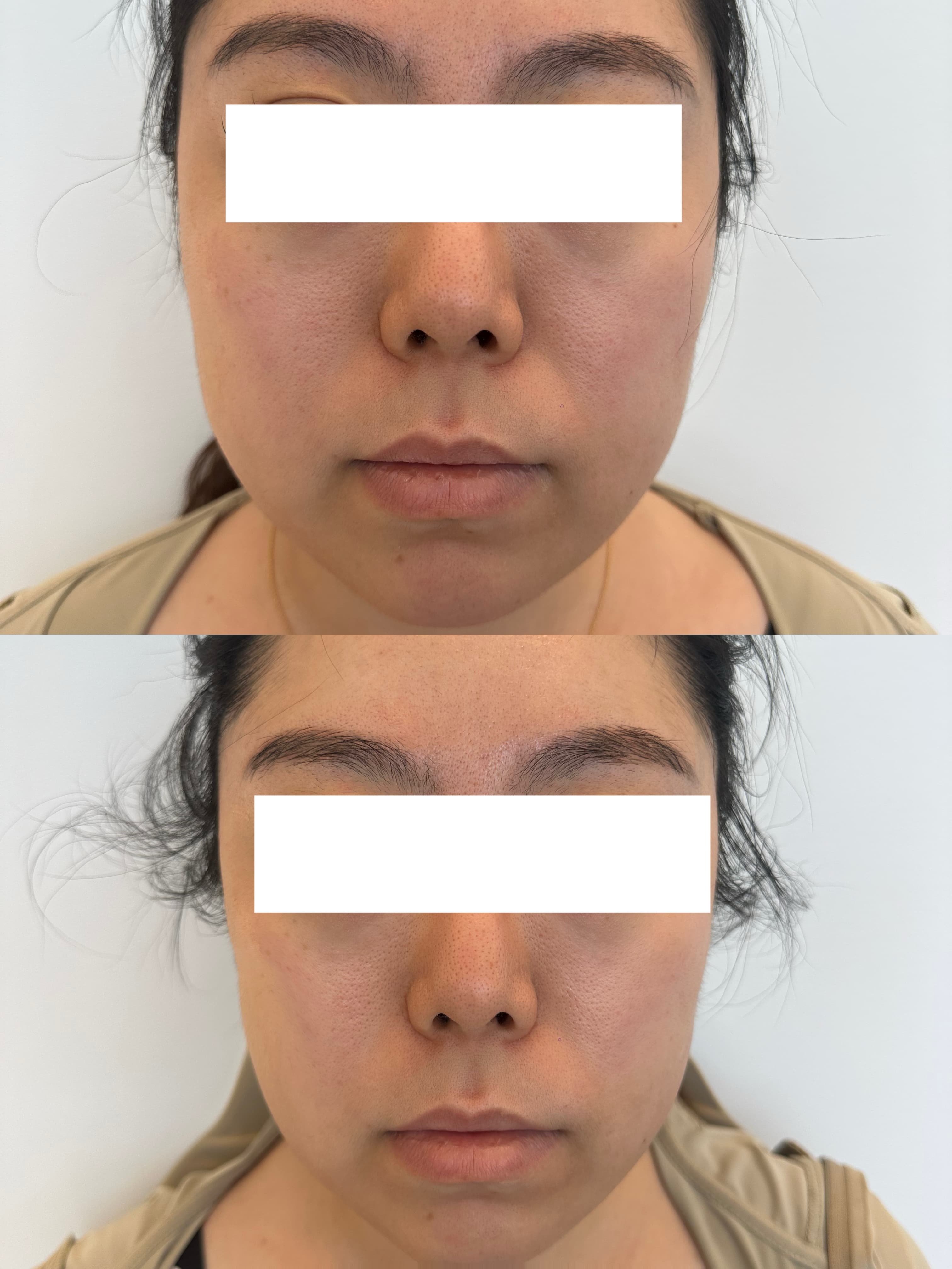 Before and after photos of a woman's face showing a slimmer, more contoured jawline.