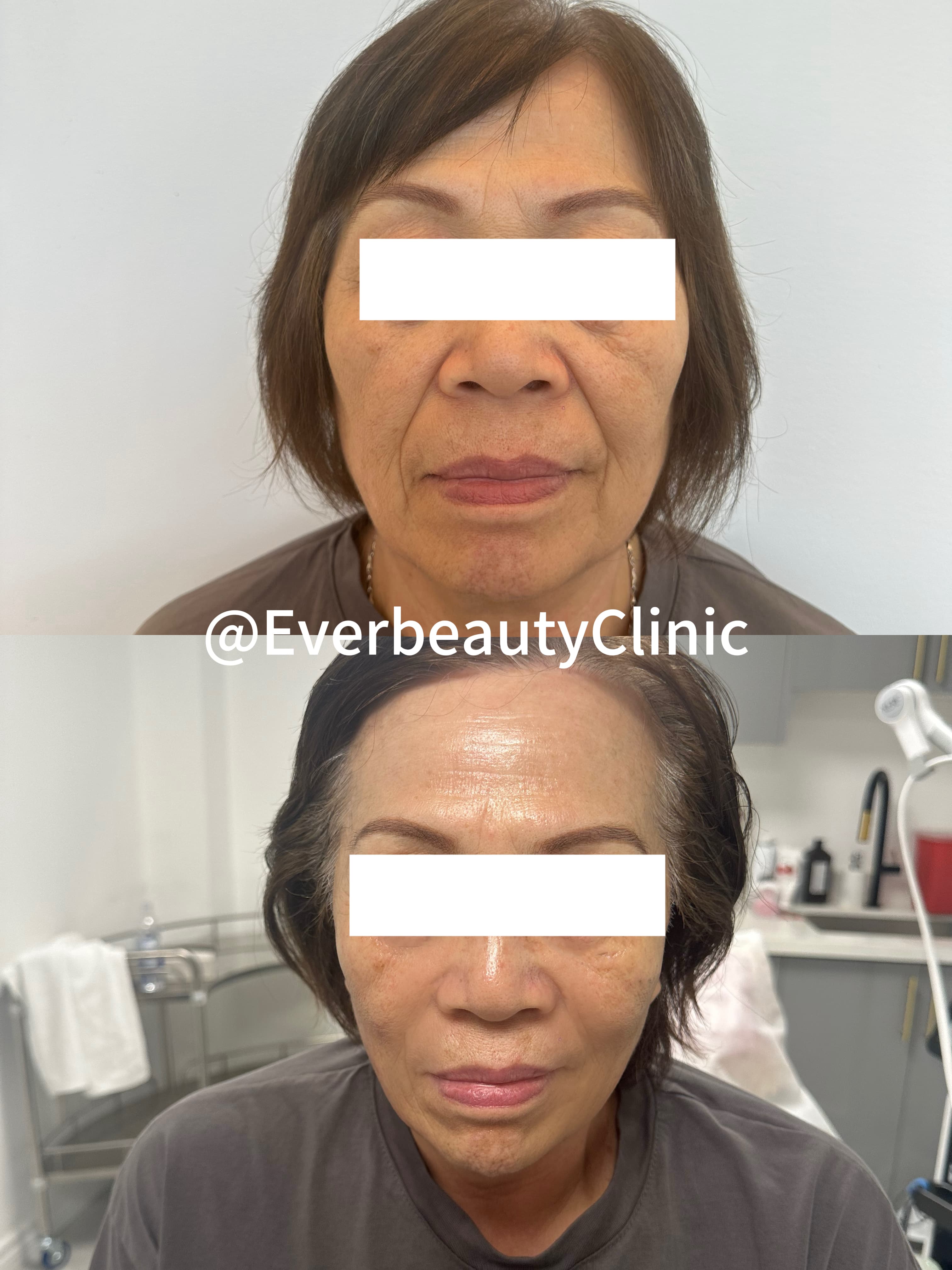 Before and after comparison of a woman's face showing reduced wrinkles and improved skin texture.