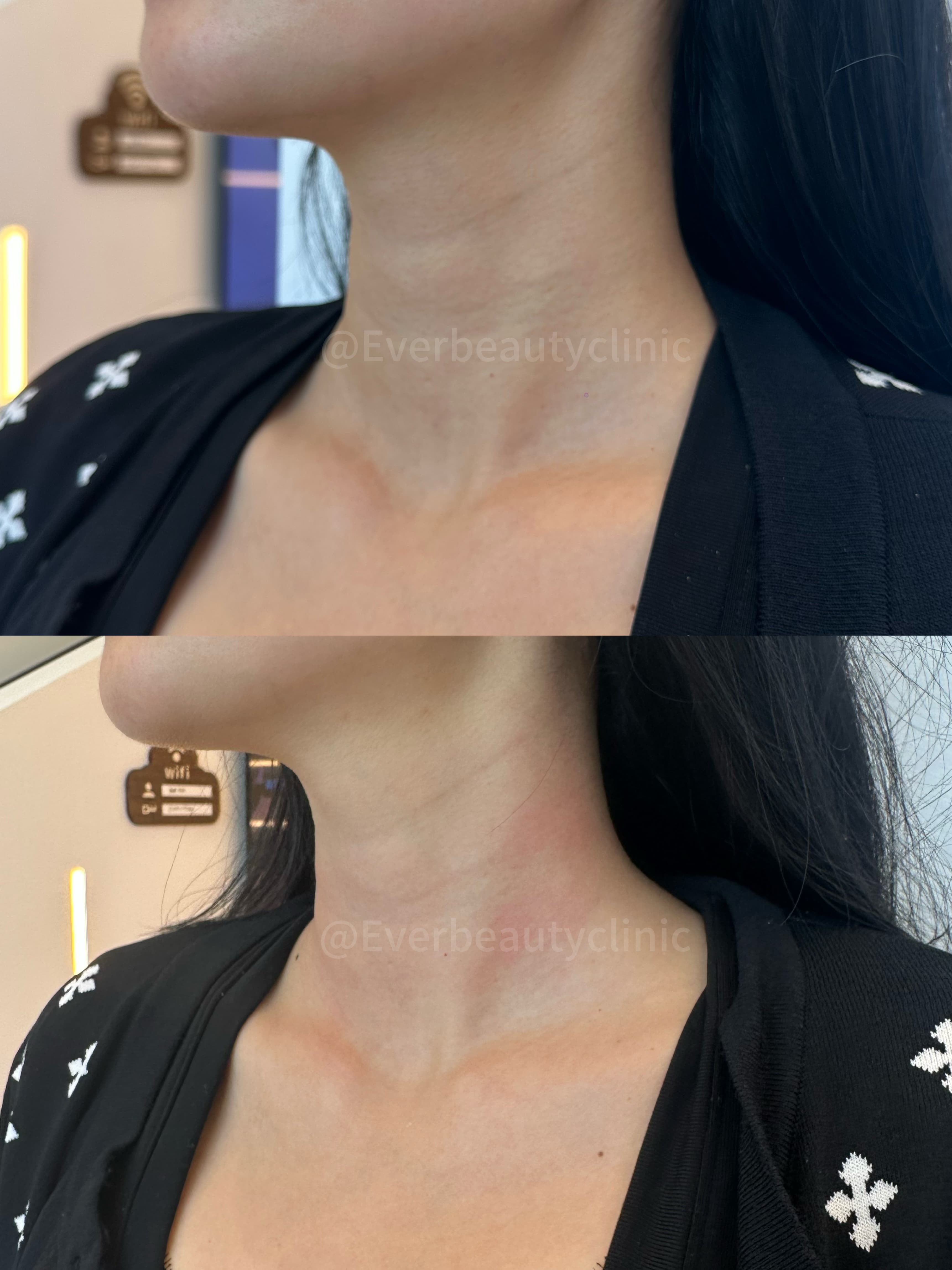 Before and after comparison of a woman's neck showing reduction in horizontal neck lines.